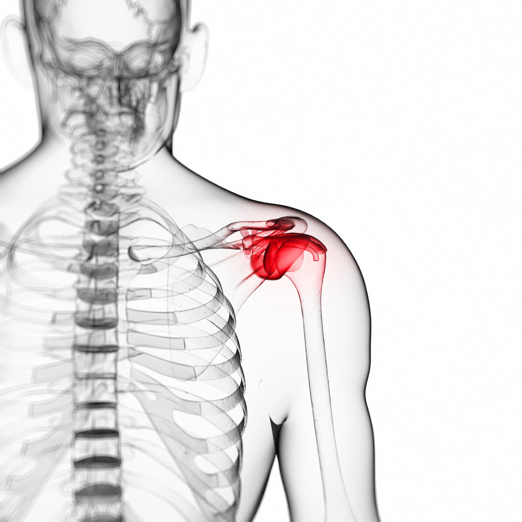 3 ways to avoid frozen shoulder surgery and recover faster