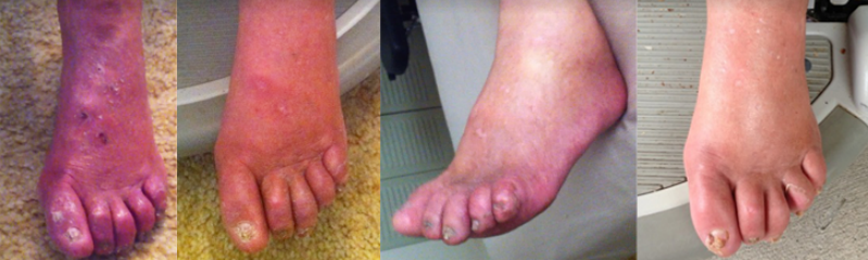 Diabetic Neuropathy