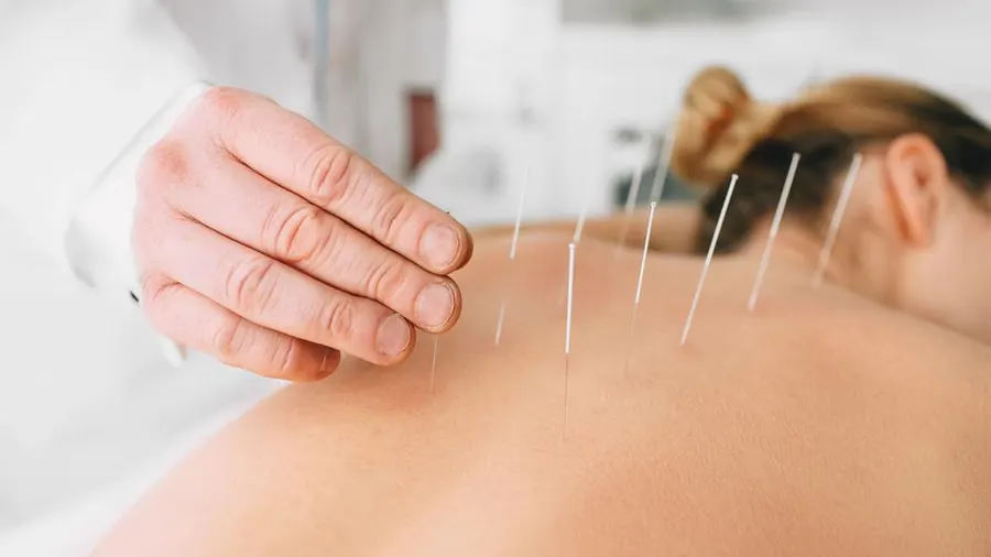 Acupuncture.jpeg
