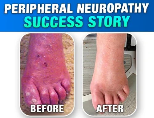 Successful Treatment of a Diabetic Peripheral Neuropathy (DPN) using MPS Therapy