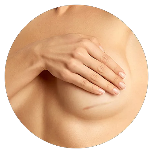 Breast Scar Therapy